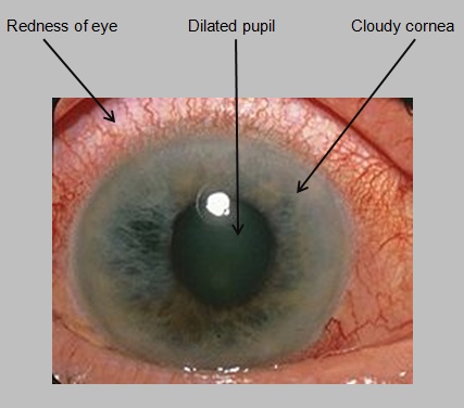 Example of acute angle closure glaucoma